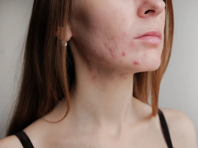dermatite perioral