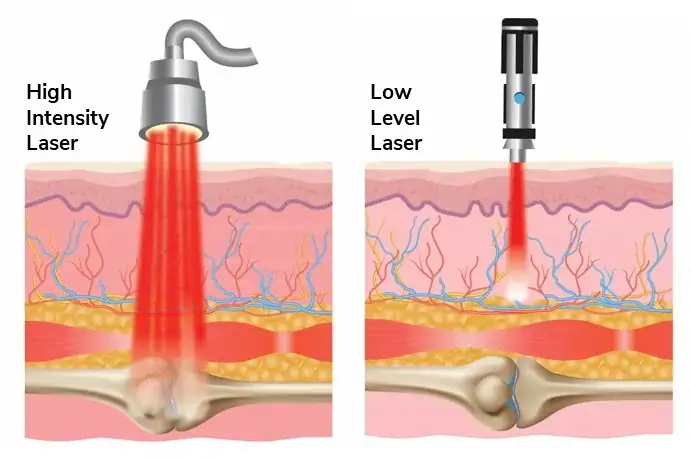 Como Funciona a Terapia com Laser de Alta Intensidade 2 diferenca de laser alta e baixa intensidade