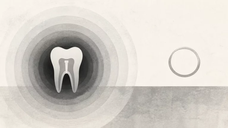 Ilustração editorial abstrata em tons de cinza sobre dor no dente que fez canal