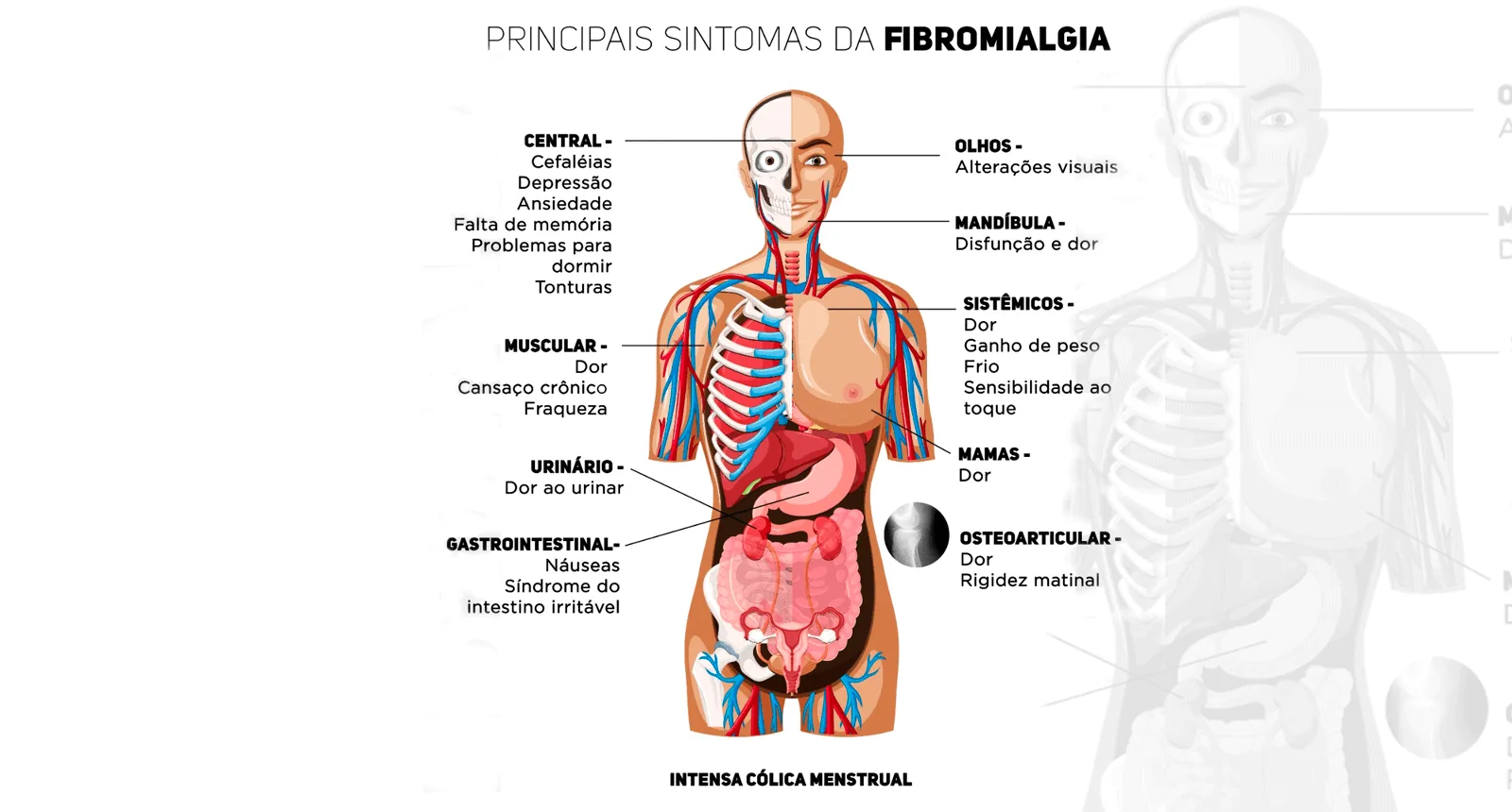 fibromialgia