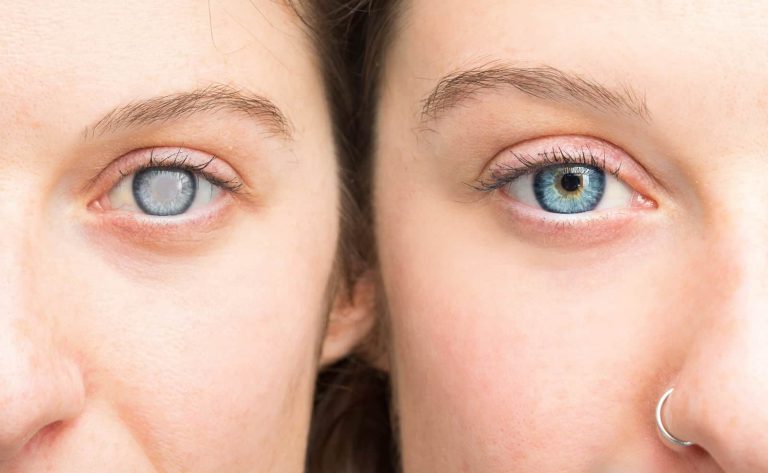 Glaucoma: avanços no tratamento e cuidados essenciais