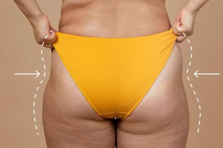 Desmistificando os 'Hip Dips': A Verdade Sobre Anatomia, Exercícios e Soluções Estéticas 4 hip dips o que fazer