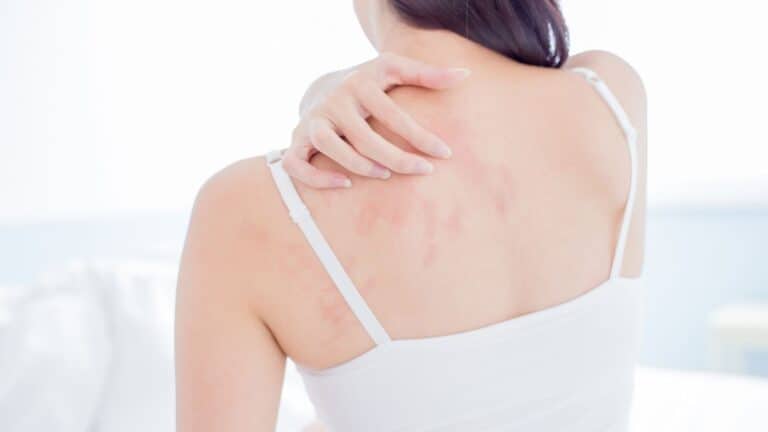 Tratamento para Eczema
