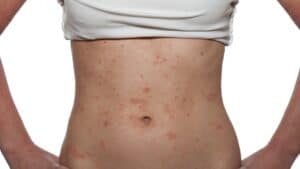 Tratamento para dermatite de contato 19 Tratamento para dermatite de contato
