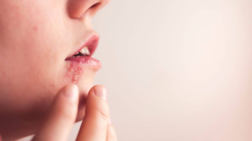 Tratamento para herpes simples: como funciona 1 Tratamento para herpes simples