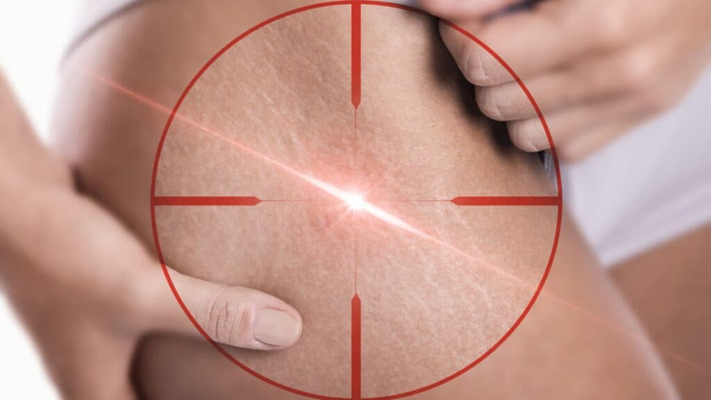Tratamento a Laser para Estrias 4 Tratamento a Laser para Estrias