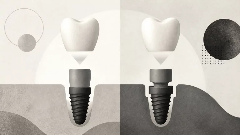 Ilustração editorial abstrata em tons de cinza sobre implante dentario sem parafuso
