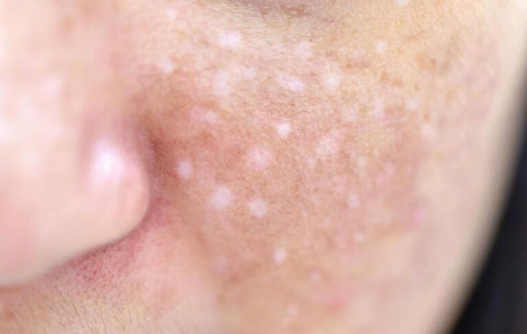 Sardas brancas: leucodermia gutata e tratamento 12 Sardas brancas: leucodermia gutata e tratamento