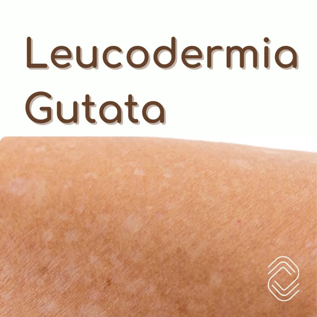 Sardas Brancas (Leucodermia Gutata): O Que São, Por Que Aparecem e Quais os Tratamentos Disponíveis? 2 leucodermia gutata 1