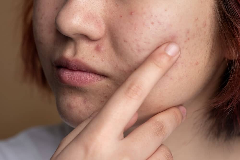 manchas de acne