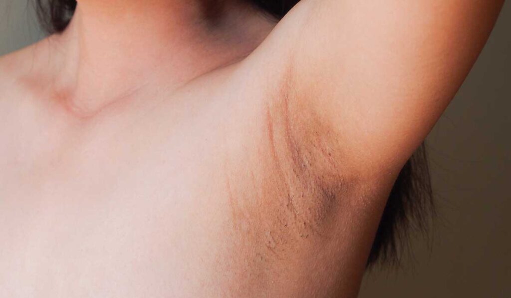 Axilas Escuras (Manchas nas Axilas): Guia Completo Sobre Causas, Prevenção e Tratamentos Dermatológicos 3 manchas escuras axilas o que fazer