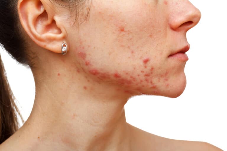 manchas vermelhas de acne