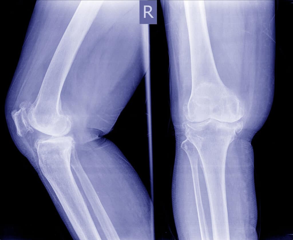 Osteoartrose de joelho: sintomas, tratamento e cuidados 1 Osteoartrose de Joelho