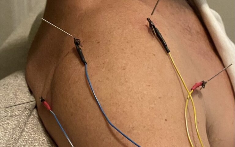 PENS: Guia Completo para Pacientes sobre a Estimulação Elétrica Nervosa Percutânea 3 pens