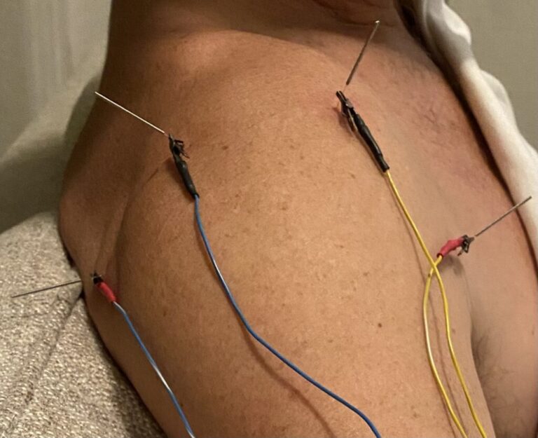 PENS: Guia Completo para Pacientes sobre a Estimulação Elétrica Nervosa Percutânea