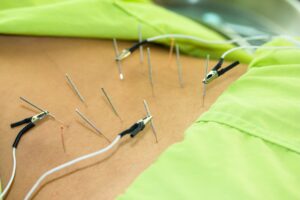 PENS na Dor Pélvica Crônica: Quando os Nervos Fora da Coluna são a Chave 19 pens eletroacupuntura estimulacao