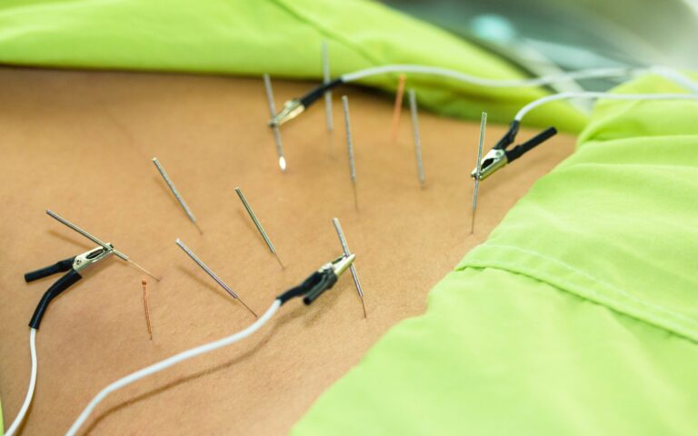 pens eletroacupuntura estimulacao