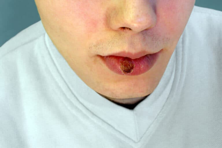 sífilis na boca