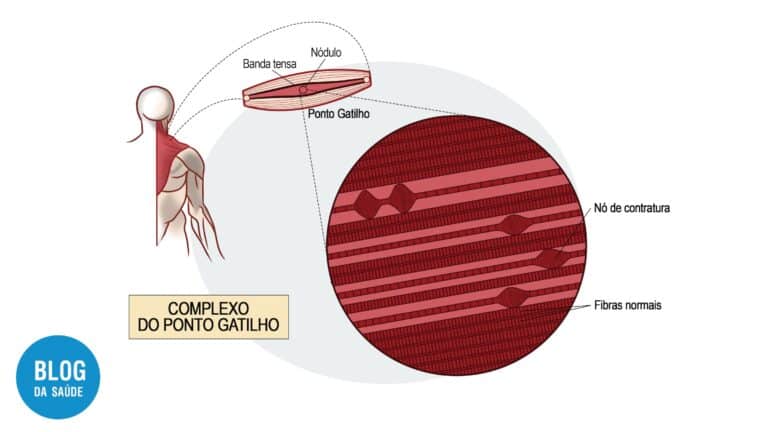 Pontos-gatilho: ativos, latentes e dor muscular 13 pontos-gatilhos-1