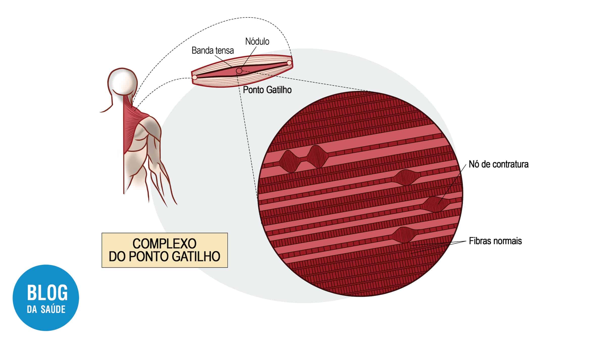 Pontos-Gatilho: Desvendando os Nós Musculares que Causam Dor - Ativos vs. Latentes 7 pontos-gatilhos-1
