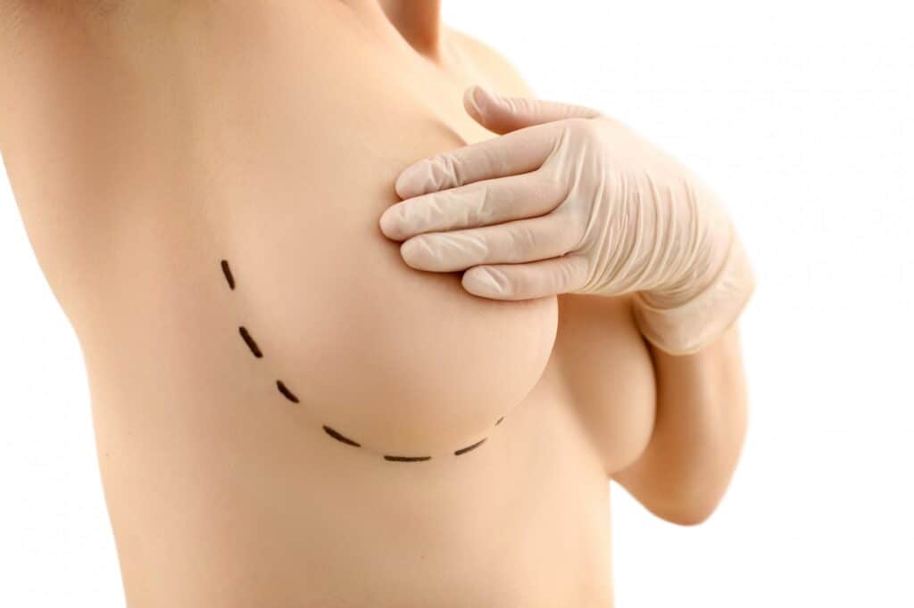 Pós-operatório de silicone: cicatriz, cuidados e alertas 1 pos operatorio cirurgia silicone mamas