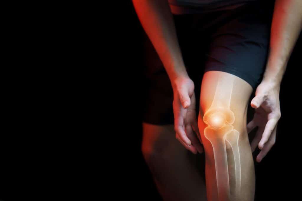 Edema Ósseo - Osso inflamado - Aprenda mais 1 raio-x joelho edema osseo