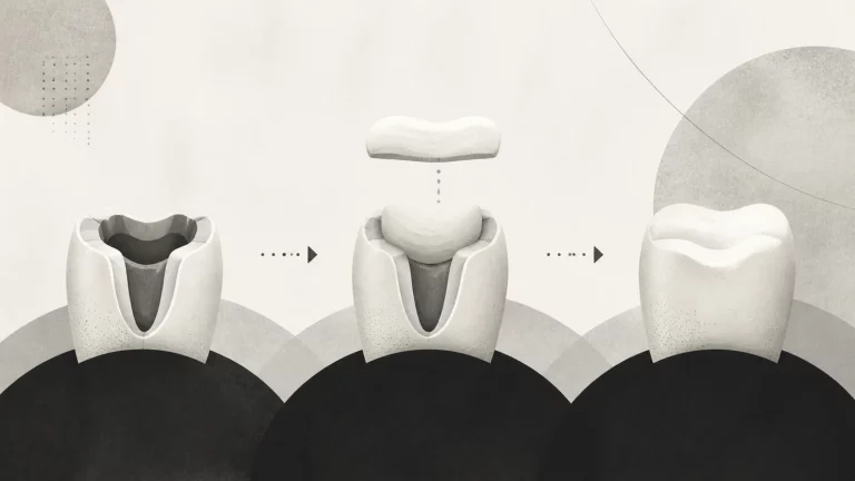 Ilustração editorial abstrata em tons de cinza sobre quanto tempo depois do canal pode fazer restauração