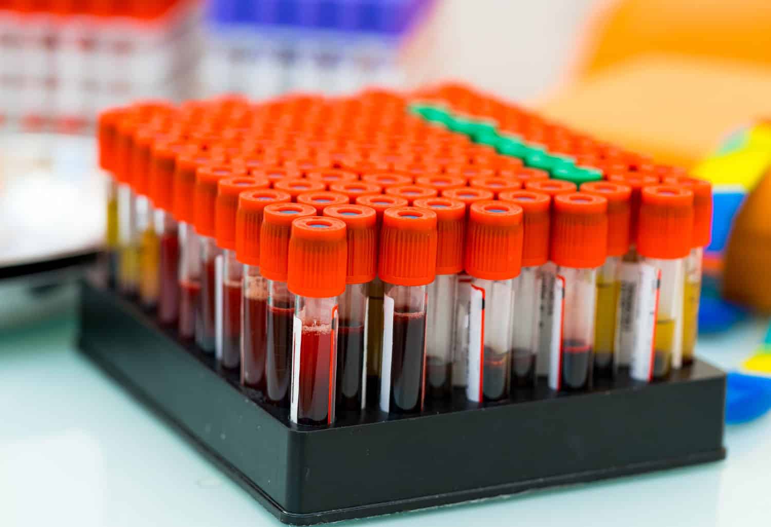 Exame de Catecolaminas: Para que Serve e Como é Realizado 3 sangue teste