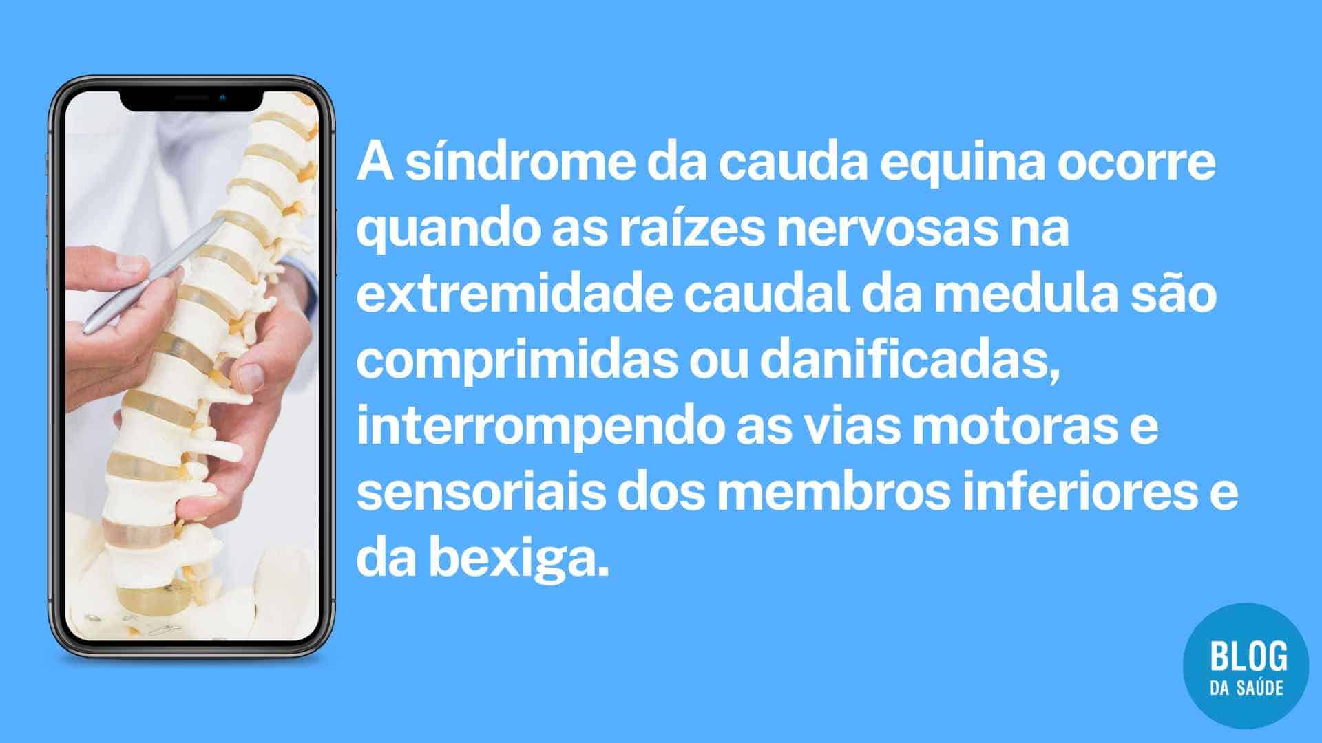 Síndrome Da Cauda Equina - Aprenda Mais! - Blog Da Saúde