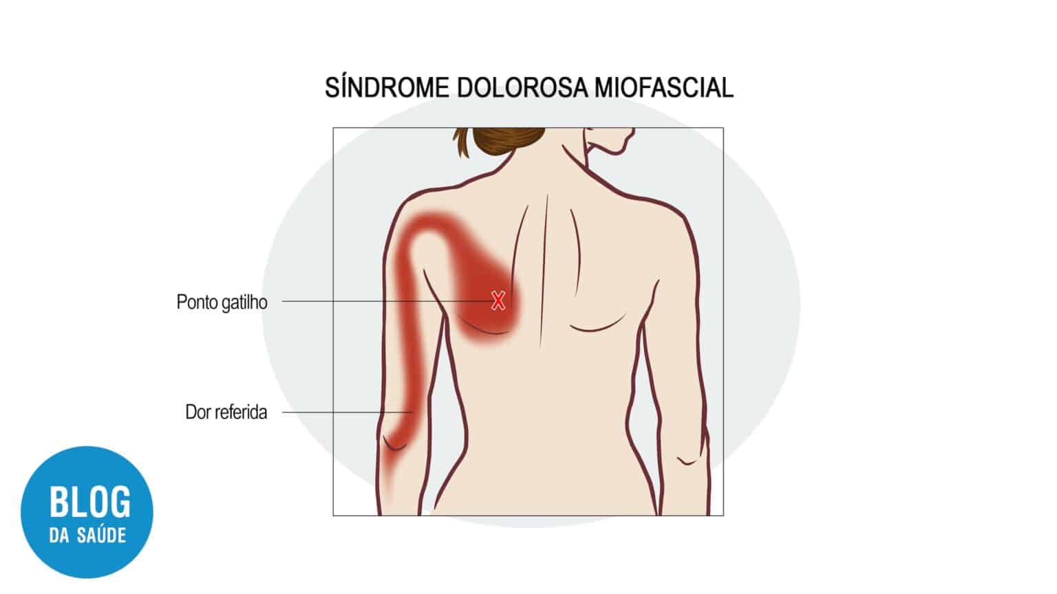 Dor Na Escápula - Causas, Sintomas E Tratamentos - Blog Da Saúde