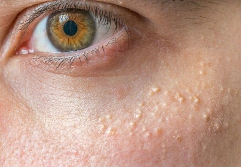 Siringoma