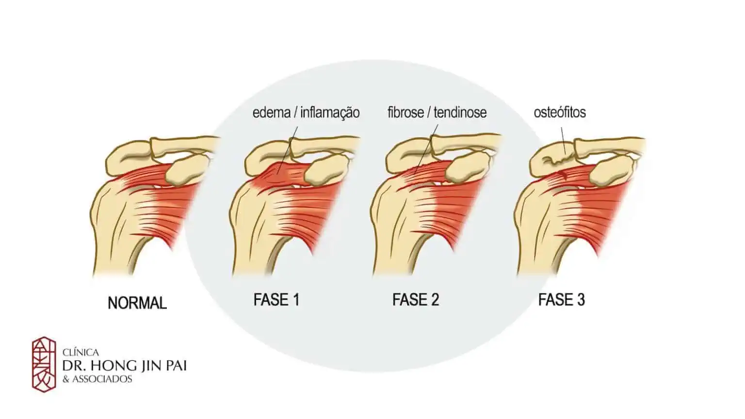 síndrome do impacto no ombro o que é causas sintomas e tratamentos