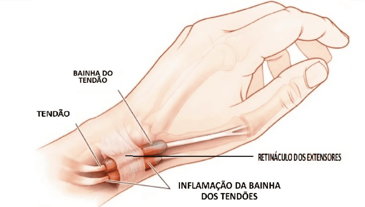 tendinite quervain