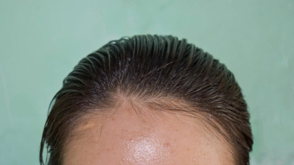 Cabelos Oleosos: Um Guia Dermatológico Sobre Causas, Mitos e a Rotina de Cuidados Ideal 3 tirar oleosidade do cabelo caseiro