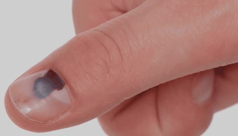Unha Preta: O que pode ser, como tratar e quando buscar ajuda? 8 Unha preta