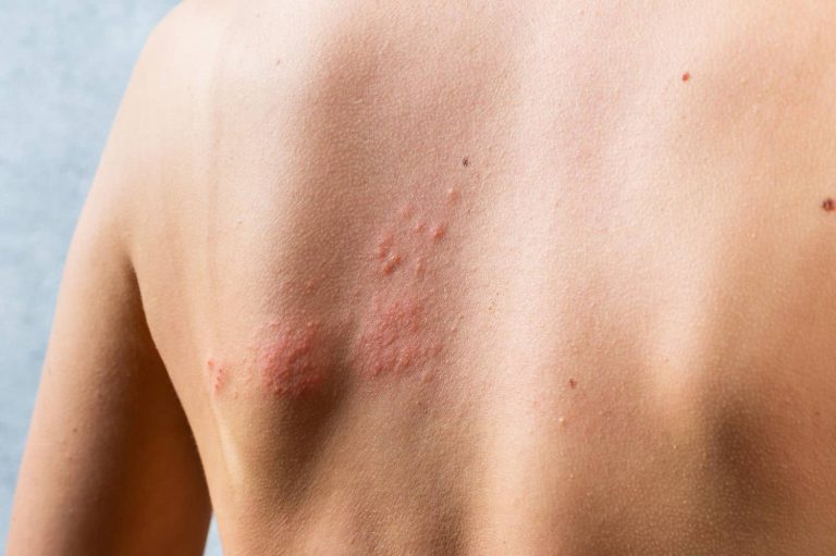 urticaria