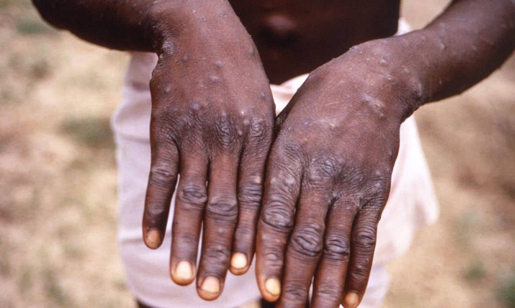 variola dos macacos monkeypox